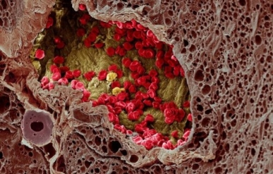 Ученые смогли превратить раковые клетки в здоровые