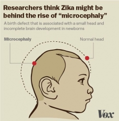 Вирус Зика убивает развивающийся мозг: американские ученые